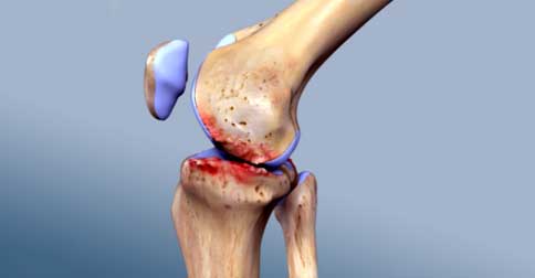 استئو آرتریت زانو