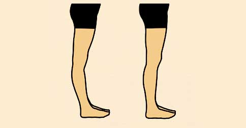 عقب زدگی زانو