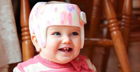 براکی سفالی در نوزادان چیست و چطور درمان می شود؟