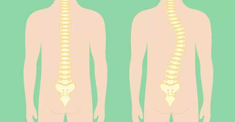 اسکولیوز عصبی عضلانی