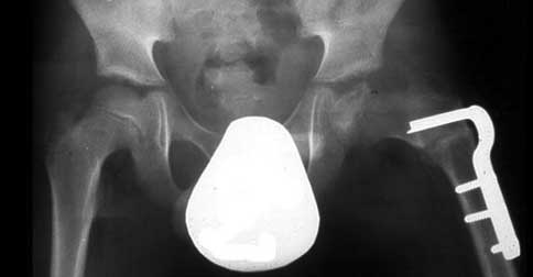 بیماری پرتس