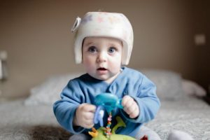 baby-wearing-corrective-helmet